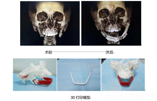 口腔科3D打印技术辅助下重建下颌骨效果理想