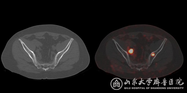 核医学科完成山东省首例PSMA PET/CT显像