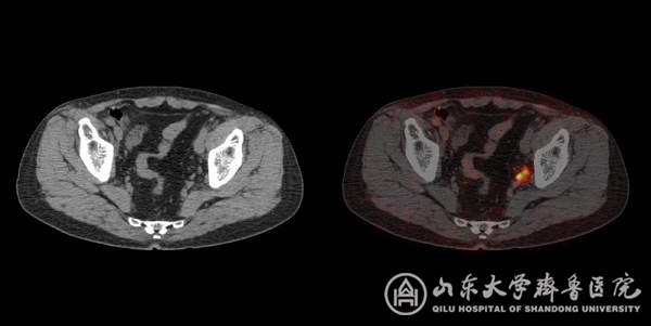 核医学科完成山东省首例PSMA PET/CT显像