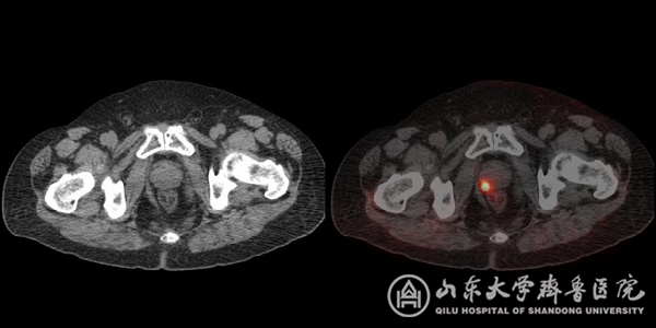 核医学科完成山东省首例PSMA PET/CT显像