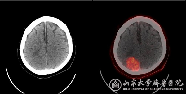 核医学科完成山东省首例PSMA PET/CT显像