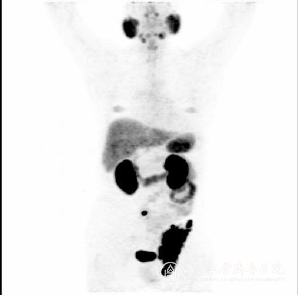 核医学科完成山东省首例PSMA PET/CT显像