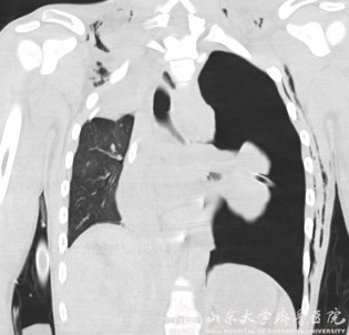 MDT与ECMO强强联手，齐鲁医院成功救治支气管断裂病人一例