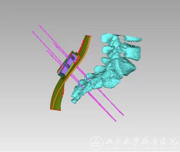 泌尿外科开展3D打印技术引导下骶神经调控术