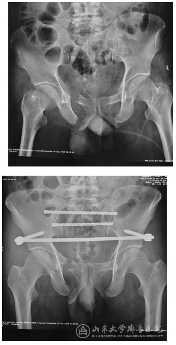 齐鲁医院成功完成首例骨科机器人手术