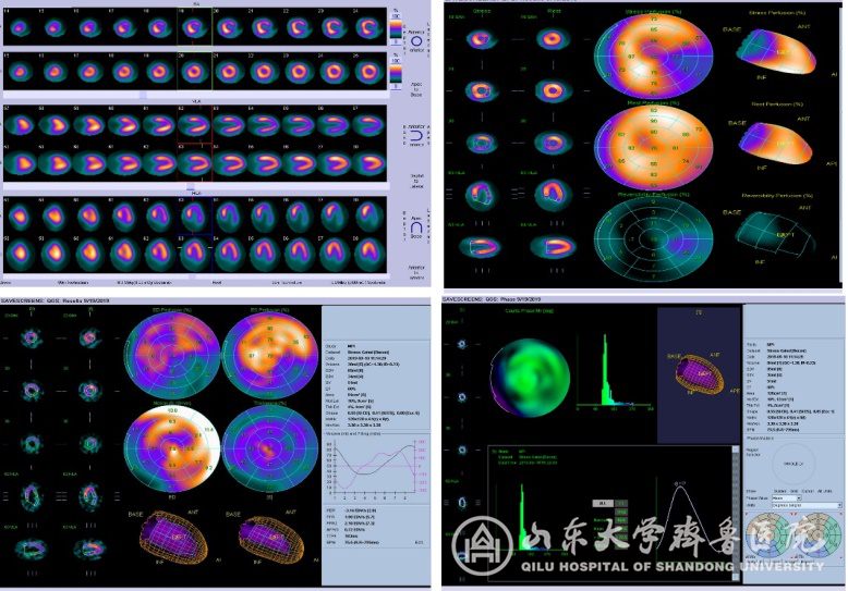 核医学科引进全球先进西门子Intevo 16 SPECT/CT新机器