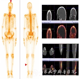 核医学科引进全球先进西门子Intevo 16 SPECT/CT新机器