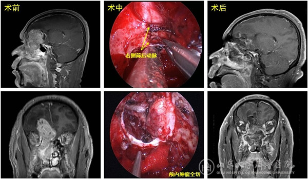医院完成内镜经鼻腔颅内外贯通巨大肿瘤切除手术