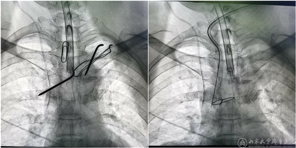 齐鲁医院多学科协作完成一例复杂高危纵膈钢针异物取出术