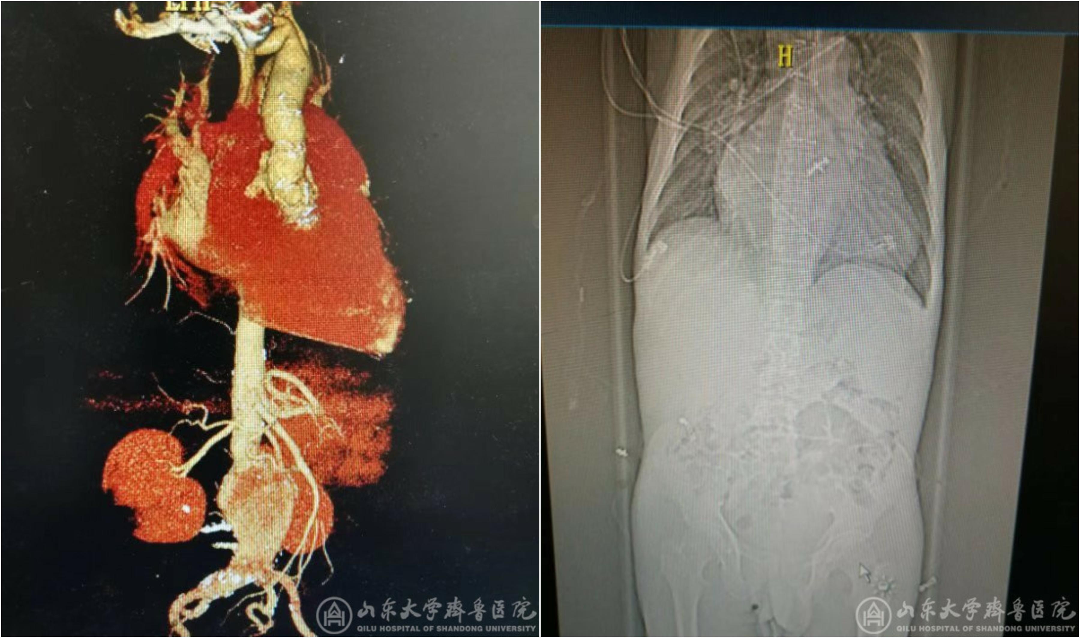 心外科成功实施医院首例同期腹主动脉瘤腔内隔绝术和二次开胸心脏二尖瓣置换、三尖瓣成形术