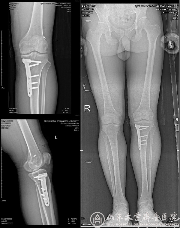 青岛院区成功实施全国首例前交叉韧带翻修+胫骨高位截骨二合一手术