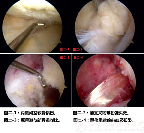 青岛院区成功实施全国首例前交叉韧带翻修+胫骨高位截骨二合一手术