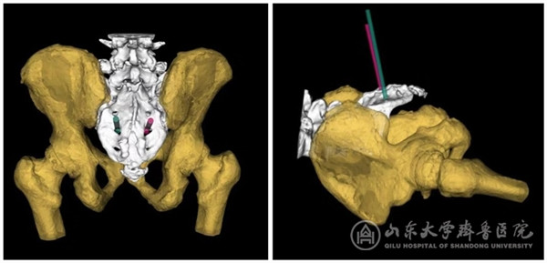 全国首例“AR（增强现实）”骶神经调控手术在齐鲁医院顺利完成
