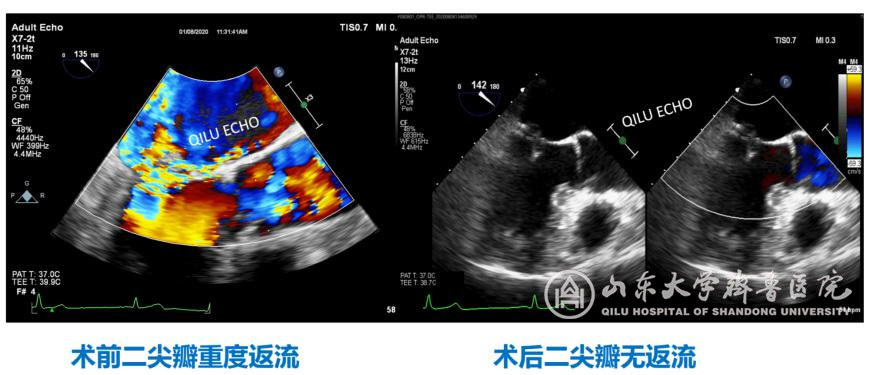 心脏外科成功完成山东省首例经导管二尖瓣修复术（MitralStitch）