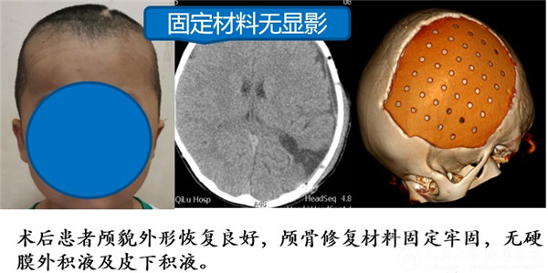 神经外科宫杰教授团队完成省内首例儿童颅骨缺损无金属化修补手术