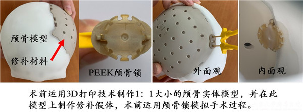 神经外科宫杰教授团队完成省内首例儿童颅骨缺损无金属化修补手术