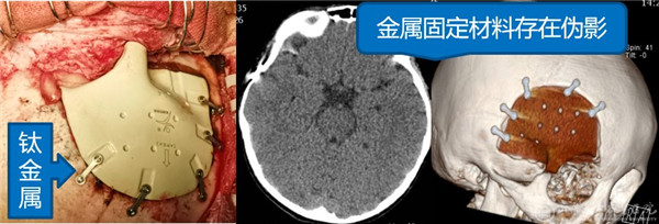 神经外科宫杰教授团队完成省内首例儿童颅骨缺损无金属化修补手术